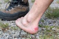 Puchýře_prevence_jak-se-zbavit30